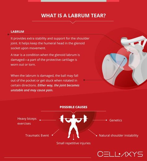 What Is a Labrum Tear Labrum Tear Shoulder, Torn Labrum, Shoulder Dislocation, Rotator Cuff Tear, Rotator Cuff, Lift Heavy, Shoulder Pain, Anatomy Reference, Health Info