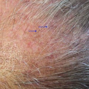 Follicular lichen planus, lichen planopilaris Lichen Planopilaris, Scarring Alopecia, Lichen Planus, Scalp Problems, Consent Forms, Frontal Hairstyles, Medical Terms, Quote Life, Ffa