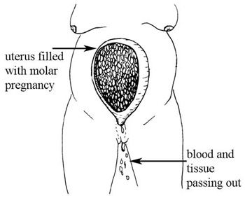 Fundal Height, Antenatal Care, Molar Pregnancy, Child Nursing, Session 9, Losing A Baby, Amniotic Fluid, Gestational Age, Pregnancy Info