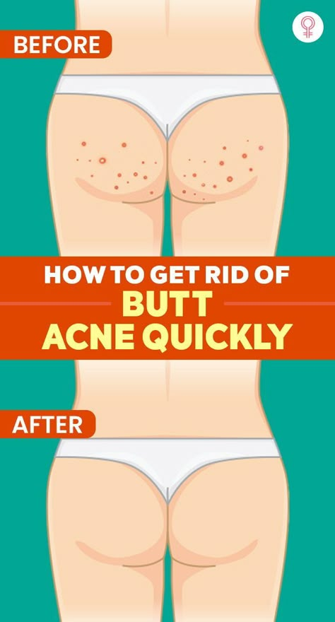 How To Get Rid Of Hair Down There, Leg Acne Remedies, How To Get Clear Buttocks, Leg Cleaning At Home, But Acne, Smooth Buttocks Skin, How To Get Rid Of Inner Thigh Pimples, How To Get Rid Of Pimples On Buttocks, How To Take Care Of My Body Skin