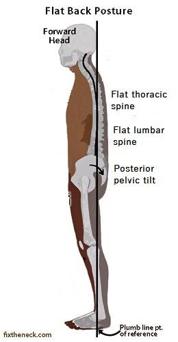 How to fix Flat back posture - Posture Direct Winged Scapula Exercises, Scapula Exercises, Winged Scapula, Better Posture Exercises, Posture Correction Exercises, Physical Therapy Student, Back Posture, Back Posture Corrector, Arm Workout Women