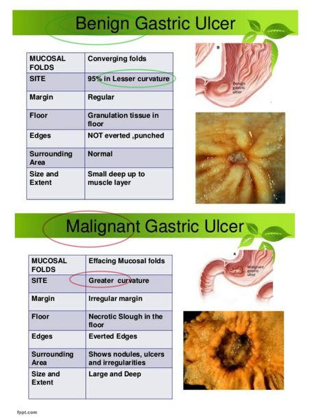 Gastric Ulcer ... #Malignant Granulation Tissue, Floor Edging, English Lessons, Surgery, Anatomy, Medical, Google Search, Quick Saves