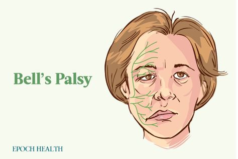 A fairly common neurological condition, Bell’s palsy typically resolves within a few weeks or months in up to 80 percent of patients. Bell’s Palsy, Muscles Of The Face, Bells Palsy, Observational Study, Cranial Nerves, 80 Percent, Facial Exercises, Facial Muscles, Blood Test