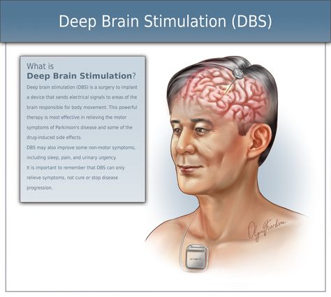 Deep Brain Stimulation (DBS). Medical illustration, on ArtStation at https://www.artstation.com/artwork/5Bl3zE Deep Brain Stimulation, Brain Stimulation, Infographic Illustration, Wacom Intuos, Illustration Style, Medical Illustration, Neurology, Portrait Artist, Side Effects