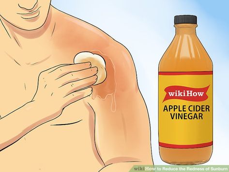 The Best Ways to Reduce the Redness of Sunburn - wikiHow Apple Cider Vinegar Sunburn, Sunburn On Face, Vinegar For Sunburn, Redness On Face, Get Rid Of Sunburn, Heal Sunburn, Bad Sunburn, Sunburn Remedies, Sunburn Relief