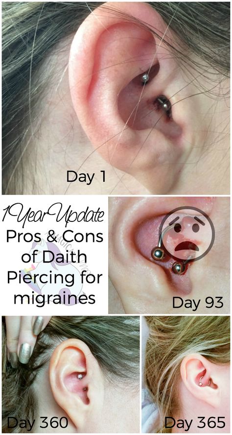 Migraine Piercing - 1 Year Results After Daith Piercing for Headaches Piercing For Headaches, Piercing No Lóbulo, Daith Piercing Migraine, Migraine Piercing, Piercing Healing, Headache Relief Instant, Migraine Pain, For Headaches, Faux Piercing