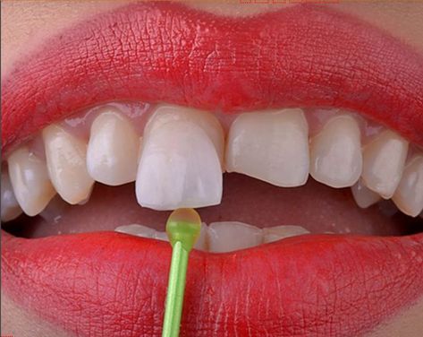 Porcelain Veneers cost in India Composite Veneers, Porcelain Veneers, Dental Veneers, Smile Makeover, Dental Lab, Smile Design, Natural Teeth, Mumbai India, Cosmetic Dentistry