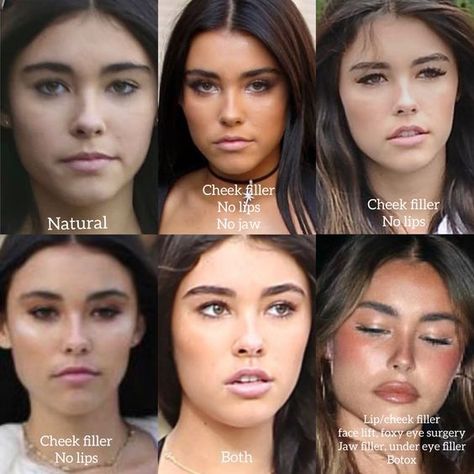 Jaw Implant Before And After, Brows And Lips Makeup, Madison Beer Plastic Surgeries, Jaw And Chin Filler, Filler Nose Job Before After, Nose Tip Filler, Eyebrow Botox Lift, How To Lift Your Eyes, Madison Beer Lip Fillers