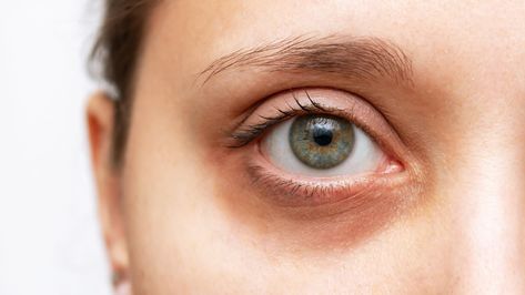 Dermatologist Doctor, Types Of Eyes, Remove Dark Circles, Under Eyes, Dark Circles Under Eyes, Dark Circle, Eyes Problems, Dermal Fillers, Lack Of Sleep