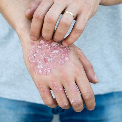 Can improving insulin resistance help manage psoriasis? 🌿 Research suggests there might be a connection. The ketogenic diet, known for improving insulin sensitivity, could also reduce psoriasis symptoms. Could diet be the key to better skin health? #psoriasis #insulinresistance #ketogenicdiet #inflammation #healthyskin #303bbq #thehealthypitmaster Prediabetic Diet, Insulin Sensitivity, Insulin Resistance, Better Skin, Skin Health, Ketogenic Diet, Healthy Skin, You Nailed It, Diet