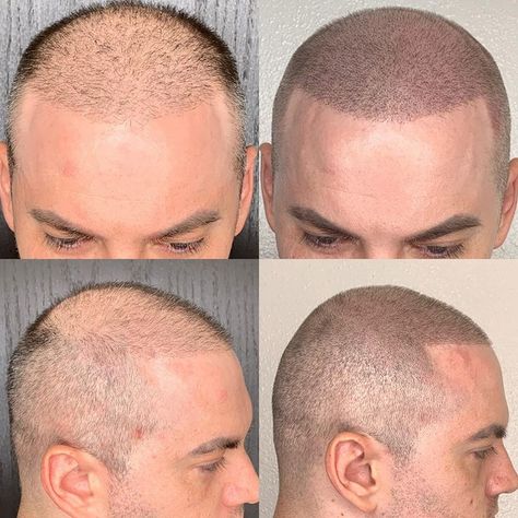 Micro Scalp Pigmentation, Kevin Murphy Scalp Spa, Bald Head Tattoo, Micro Pigmentation, Hair Transplant Video, Men’s Microblading, Modern African Clothing, Scalp Micropigmentation, Rancho Cucamonga California