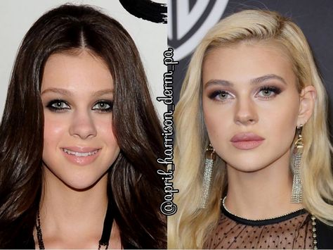 Nicola Anne Peltz, Group Cosplay, Nicola Peltz, Nicolas Peltz, Kylie J, Cosmetic Dermatology, Lip Fillers, I Spy, Cosmetic Surgery