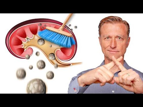 Clean Out Your Kidneys of Oxalates and Stones - Dr. Berg - YouTube Renal Physiology, Low Oxalate Diet, Oxalate Diet, Low Oxalate, Ab Diet, Dr Eric Berg, Eric Berg, Dr Berg, Nutrient Deficiency