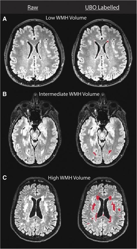 White matter hyperintensities are common in midlife and already associated with cognitive decline | Brain Communications | Oxford Academic White Matter In Brain, Computational Biology, Caregiver Resources, Cholesterol Medications, White Matter, Atrial Fibrillation, Blood Pressure Medications, Magnetic Resonance Imaging, Magnetic Resonance