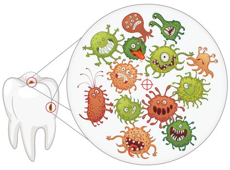 Some bacteria in plaque are harmless, but some are harmful for the health of your gums. If you don't remove plaque from your teeth by brushing them, it builds up and irritates your gums. This can lead to redness with bleeding, swelling and soreness. Implant Dentist, Remedies For Tooth Ache, Coconut Oil For Teeth, Coconut Benefits, Family Dentist, Dental Bridge, Coconut Oil Pulling, Best Teeth Whitening, Dental Humor