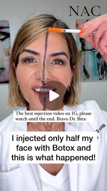 Erika Barry on Instagram: "Bravo @nacmedspa …. This is best injector/injection video on IG!!! 🎉🎉The importance of injecting your DAO PLUS your superficial plats….if you just inject your DAO, and your superficial plats recruit… your jowls will worsen. So consider injecting both plats and dao! - I’m speaking on this topic @modernbeautycon this 6/29!!!! - Make sure to follow @drbitafarrell @nacmedspa  👇🏻👇🏻👇🏻 Muscles of the face either pull up or pull down.  When the muscles that pull the lower face down (platysma and DAO) are injected and relaxed with a Neuromodulator such as Botox, the muscle that pulls the mid face up (zygomaticus or cheek muscle) dominates and pulls the face up!  This can help reduce the appearance of marionette lines, jowls, frown (rbf, or sad face), and the nasol Botox For Jaw Clenching, Botox For Frown Lines, Botox For Lower Face, Botox For Marionette Lines, Botox Marionette Lines, Rbf Face Aesthetic, Dao Muscle Botox Before And After, Botox Before After Jowls, Dao Botox Before After