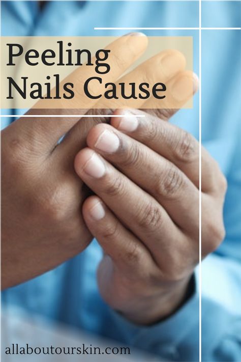 If you have a career as a hairstylist or cleaner, you may be very familiar with this situation. Constantly having your hands in water can cause brittle, split or peeling nails. Repetitive wetting and drying of hands are the most common reason for peeling nails. Dry Nails Remedy, Nail Splitting Remedies, Peeling Nails Remedy, Split Nails Remedies, Splitting Nails Remedies, Brittle Nails Causes, Strength Nails, Splitting Fingernails, Why Are My Nails Peeling