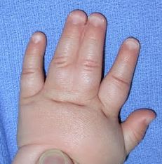 One of the characteristics of Poland Syndrome is that one hand is smaller than the other. The hand may webbed fingers, fused fingers or missing fingers altogether. We share a short story we found about this physical appearance. Paralyzer Finger Eleven, Numb Fingertips, Thumb Trigger Finger, Fractured Finger, Webbed Fingers, Hypermobility Finger Splints, Physical Appearance, A Short Story, Kids Hands