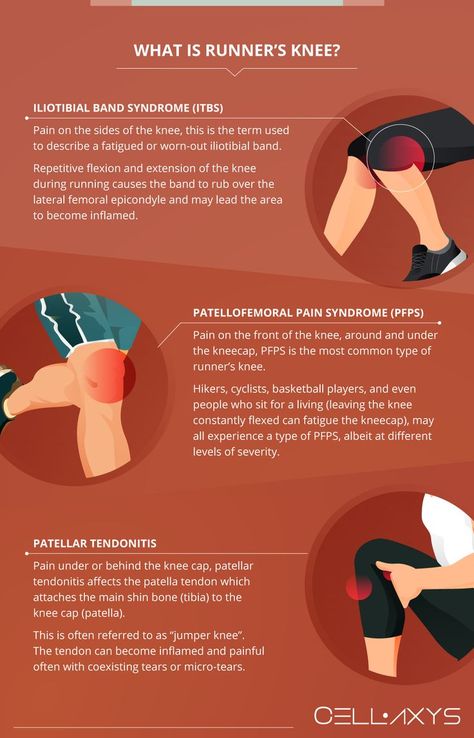 What is runner’s knee Knee Pain Relief Remedies, Vitamins For Nerves, Patellofemoral Pain Syndrome, Iliotibial Band, Swollen Knee, Neck And Shoulder Muscles, Runners Knee, Knee Problem, Pain Relief Remedies