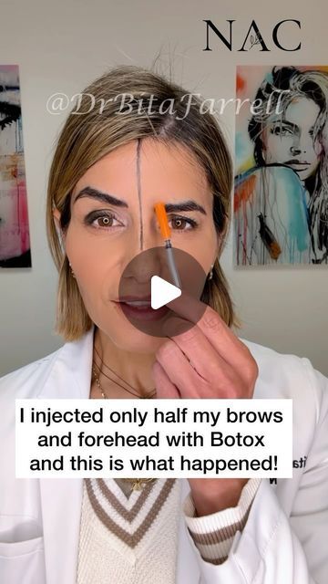 Dr. Bita Zadeh Farrell on Instagram: "Neuromodulators can be used to shape the brows and give them a lift.  Understanding facial anatomy, muscle function and vector pull is key to achieving pleasing results.  The glabellar muscles (procerus supercilii and corrugators) pull the inner brows in and down.  The obicularis oculi pulls the lateral brow in and down.  By relaxing these muscles and allowing the frontalis to dominate, you can achieve a brow lift.   Please note that individual results vary and those with moderate to severe upper lid heaviness may require surgical correction.   #browlift #browliftbotox #botoxbrowlift #botoxtraining #drbitafarrell #naturalaestheticscenter" Botox For Eyebrow Lift, Temporal Brow Lift, Brow Lift Before And After, Eyebrow Lift Botox Before And After, Botox Brow Lift Before And After, Botox Eyebrow Lift, Botox Injection Sites Eyebrow Lift, Botox To Lift Corners Of Mouth, Face Muscles Anatomy