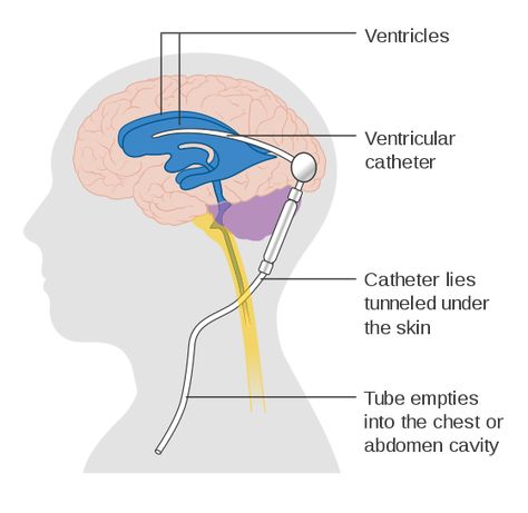 Diagram showing a brain shunt CRUK 052.svg Vp Shunt, Intracranial Pressure, Spinal Fluid, Medical Oncology, Cerebrospinal Fluid, Brain Tissue, Personalized Medicine, Vision Problems, Central Nervous System