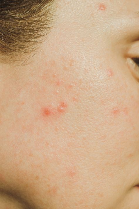 Adult acne closeup of skin with pimples and blemishes. Acne Types, Painful Pimple, Acne Vulgaris, Acne Treatments, Natural Acne Remedies, Severe Acne, Types Of Acne, How To Get Rid Of Pimples, Laser Skin