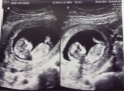 Fraternal Twins Ultrasound 12 Weeks Twin Ultrasound At 12 Weeks, Hidden Twin Ultrasound, 12 Weeks Pregnant Ultrasound, Ultrasound Pictures Gender, Twin Ultrasound, 3d Ultrasound Pictures, 12 Week Ultrasound, Twins Ultrasound, Baby Ultrasound Pictures