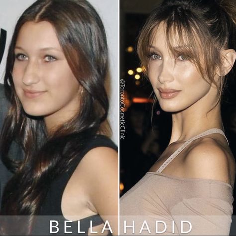 Before After Plastic Surgery Faces, Alarplasty Before After, Plastic Surgery Celebrities, Bella Hadid Nose, Plastic Surgery Aesthetic, Face Plastic Surgery, Nose Surgery Rhinoplasty, Celebrity Surgery, Teeth Aesthetic