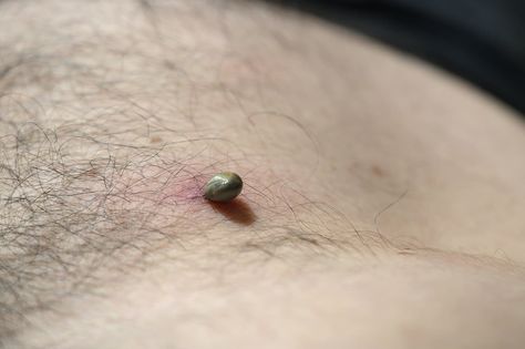 What Do Tick Bites Look Like? Tips And Pictures To Identify Them Tick Bites Pictures, Tick Bite Symptoms, Common Skin Rashes, Types Of Ticks, Body Rash, Fever Symptoms, Guillain Barre, Tick Bite, Spider Bites