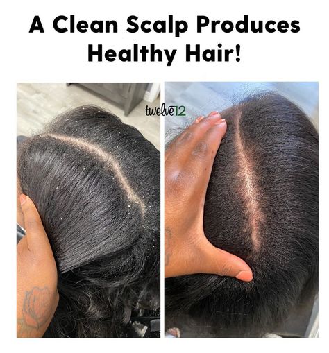 Clear Scalp, Natural Healthy Hair, Clean Scalp, Embracing Diversity, Natural Hair Care Tips, Healthy Natural Hair, Hairstyle Trends, Women's Hairstyles, Scalp Care