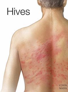 Mayo Clinic Q and A: Chronic Hives Come and Go With No Clear Pattern – Mayo Clinic News Network Hives Relief, Natural Remedies For Hives, Skin Rash Remedies, Allergy Hives, Hives Causes, Allergic Reaction Rash, Hives Remedies, Allergy Rash, Chronic Hives