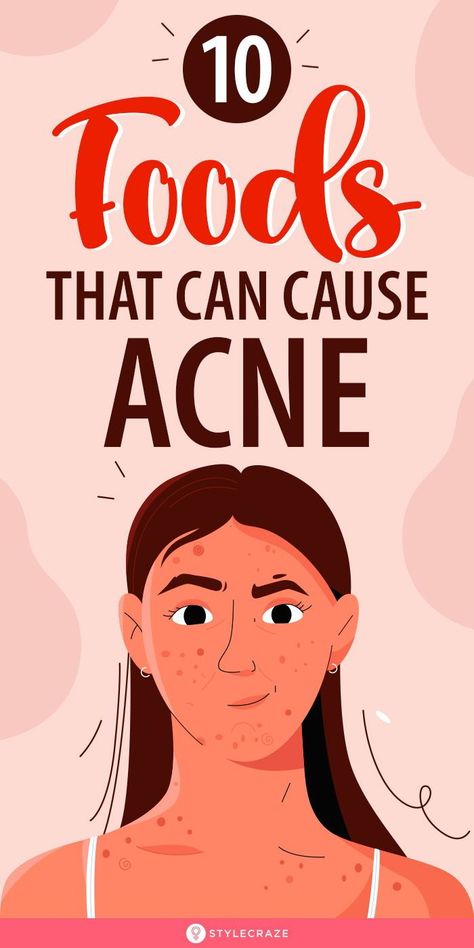 Good Skin Tips Acne, Cause Of Pimples, Causes Of Pimples, Pimple Remedies, Bump Progression, Remedy For Acne, Food For Acne, Acne Causing Foods, Pimple Causes