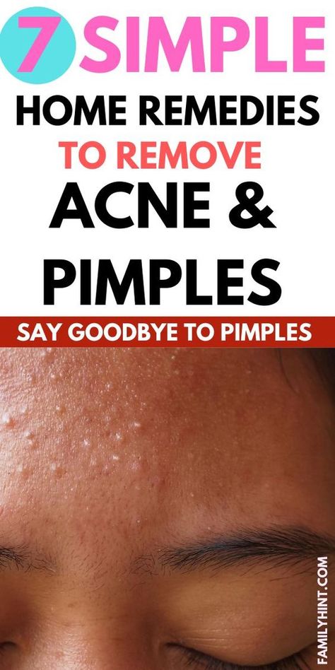 The ultimate guide to get rid of acne pimples fast at home | Clear skin tips | clear skin tips dark spots | clear skin tips for teenagers | clear skin tips pimples | clear skin tips overnight | clear skin tips for oily skin | clear skin tips skincare | foods for clear skin | clear skin products | how to get clear skin in a week | how to get clear skin fast naturally | skin care routine | skin care products | skincare Overnight Clear Skin, Skin Tips For Oily Skin, Clear Skin In A Week, Get Clear Skin Fast, Clear Skin Products, Foods For Clear Skin, How To Clear Pimples, Clear Skin Fast, Home Remedies For Pimples