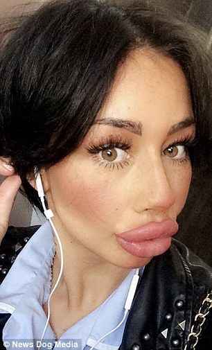 Before and after: The 30-year-old has had 6.5ml of dermal filler injected into her lips in less than a year Big Lips Natural, Lip Pictures, Wax Lips, Plastic Surgery Fail, Botox Lips, Plastic Surgery Gone Wrong, Fake Lips, Bright Lipstick, Tongue Health