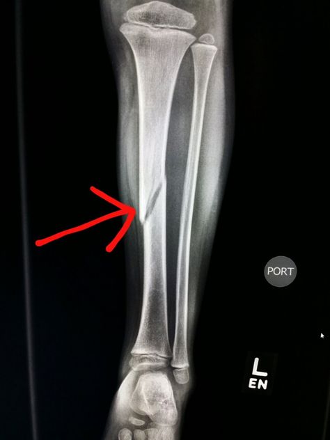 #Leg #xray shows a #spiral #fracture of the #tibia in a #child. #radiologist #radiology #trauma Leg Xray, Radius Bone, Shopping Snap, Beard And Mustache Styles, Arm Bones, X-ray Images, Plant Styling, Bone Fracture, Leg Bones