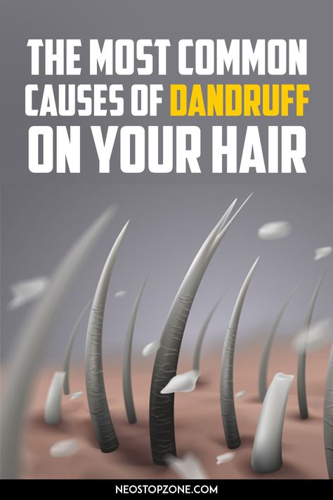 After all, People affected by dandruff is still not a nice ordeal. You can’t operate properly with dandruff because it makes your scalp itchy and results in hair fall and typically even breakouts in your face. Nipping it within the bud at first of its prevalence is the correct thing to do reasonably than deciding to dwell with it. But what's The Causes Of Dandruff actually? Causes Of Dandruff, How To Get Dandruff Out Of Hair, What Is Dandruff, What Causes Dandruff, Dandruff Causes, Scale Skin, Flaky Scalp, Hair Dandruff, Hair Issues