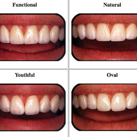 Teeth Makeover, Veneers Teeth, Partial Dentures, Beautiful Teeth, Gap Teeth, Porcelain Veneers, Perfect Teeth, Teeth Shape, Dental Veneers