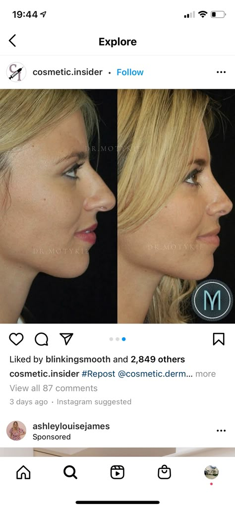 Nose Plastic Surgery, Nose Surgery Rhinoplasty, Nose Fillers, Bulbous Nose, Rhinoplasty Nose Jobs, Face Surgery, Rhinoplasty Before And After, Straight Nose, Pretty Nose