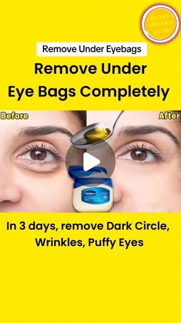 Eye Circle Remedies, Remove Dark Eye Circles, Undereye Bags Remedy, Eye Bag Remedies, Eye Health Remedies, Dark Undereyes, Dark Circle Remedies, Dark Circles Around Eyes, Natural Eye Cream