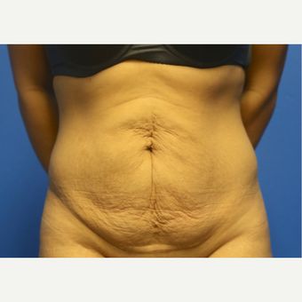 Tummy Tuck Before & After Pictures - RealSelf Mom Belly Before And After, Belly Apron Before And After, Mini Tummy Tucks Before And After, Diep Flap Before And After, Tummy Tucks Recovery Tips, Liposculpture Before And After, Tummy Tucks Before And After, Tummy Tucks Recovery, Belly Apron