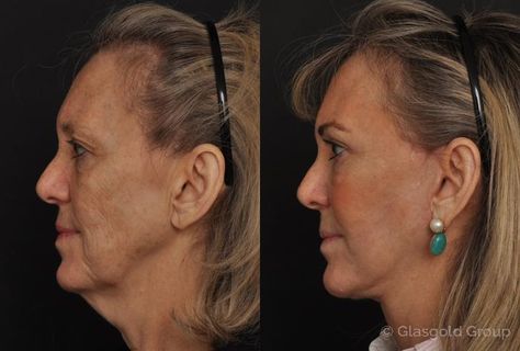 Facelift Before And After, Facelift Procedure, Salivary Gland, Fat Transfer, Polycystic Ovaries, Facial Rejuvenation, Before After Photo, After Photos, Cosmetic Surgery