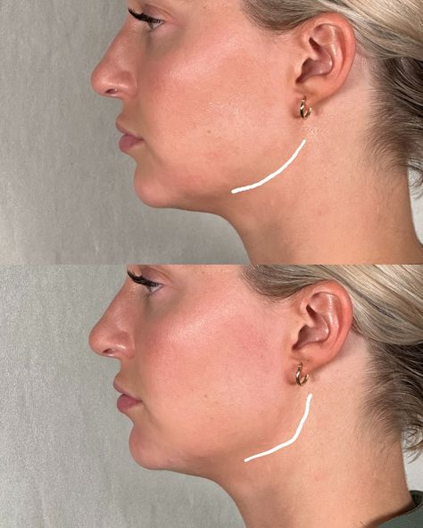 Jawline Before And After, Before And After Jawline, Jawline Fillers Before And After, Chin Fillers Before After, Chin Filler, Perfect Nose, Nose Job, After Photos, To Share