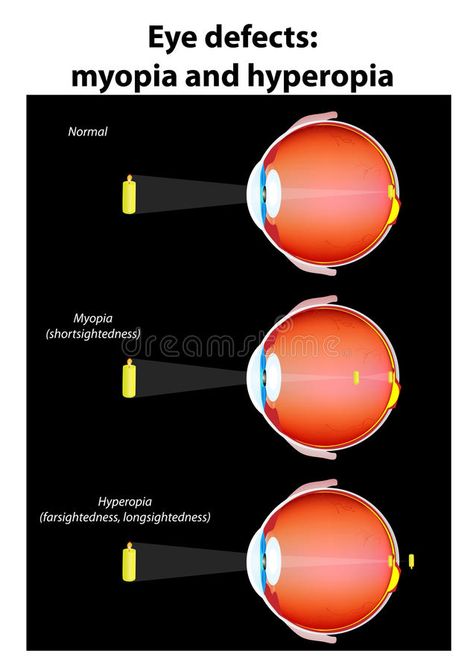 Eye optical defects : myopia and hyperopia. vector. Illustration about help, biology, clinic, healthcare, diagram, anatomy, human, myopia, illustration, focus, medical - 22592735 Human Eye Diagram, Eye Diagram, Eye Health Facts, Fruit Vegetable Smoothie, Online Doctor, Doctor Appointment, Health Smoothies, Best Doctors, Human Eye