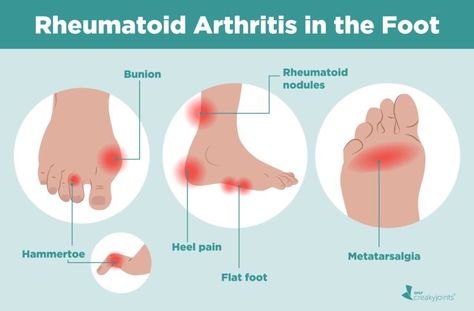 Rheumatoid Quotes, Rheumatoid Symptoms, Rheumatoid Diet, Rheumatoid Nodules, Osteoporosis Symptoms, Ra Symptoms, Sciatic Nerve Pain, Autoimmune Disorder, Naturopathy