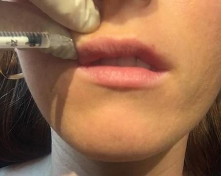 Lip Flip Review: Is It Better Than Lip Filler For A Plump Pout? Lip Injections Small Lips, Best Lip Plumper Before And After, Upper Lip Filler Before And After, How To Make Upper Lip Look Fuller, Before And After Lip Flip, Lip Botox Natural, Lip Flip Results, Botox Lips Before And After, Lip Threading Before And After