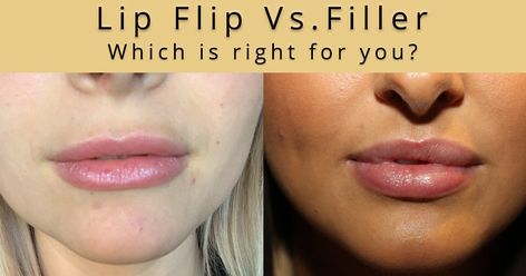 Botox Under Eyes, Botox Lip Flip, Lip Flip, Botox Brow Lift, Lip Lift, Botox Before And After, Botox Lips, Botox Face, Facial Fillers