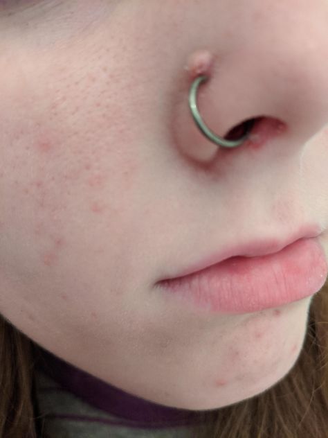 Nose Piercing Irritation Bump, Nose Piercing Bump Remedies, Bump On Nose Piercing, Nose Bump, Nose Piercing Scar, Nose Piercing Bump, Piercing Bump, Piercing Nose, The Bump