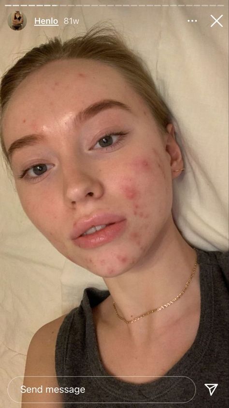 Acne Appreciation Aesthetic, Acne Face Aesthetic, People With Acne Pretty, Imperfect Skin Aesthetic, Acne Aesthetic Girl, Makeup With Acne Showing, Pimples Aesthetic, Girl With Acne Aesthetic, People With Pimples