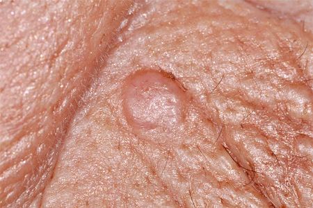 Spots On Skin, Basal Cell, Skin Disorders, Thyroid Health, Types Of Cancers, Signs And Symptoms, Dermatology, Skin Cells, Disease