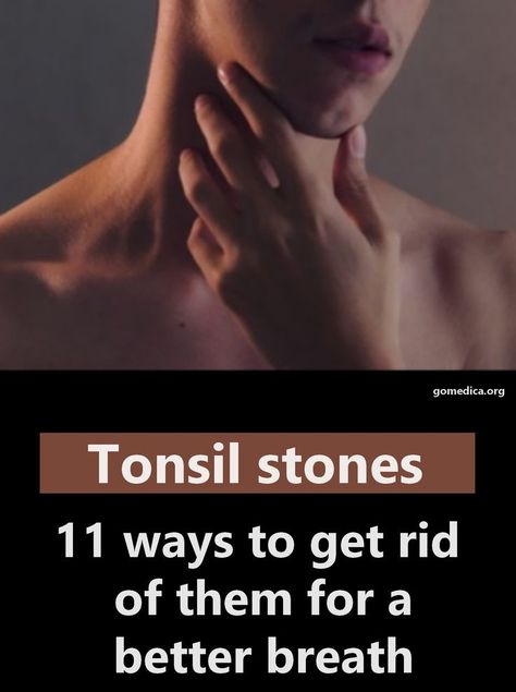 tonsil stones what causes Throat Stones Remedies, Tonsil Stone Remedies, Tonsillitis Symptoms, Natural Remedies For Swollen Tonsils, Remedies For Swollen Tonsils, Preparing For Tonsil Removal, How To Get Rid Of Tonsil Stones, Natural Remedies For Tonsillitis, Throat Health